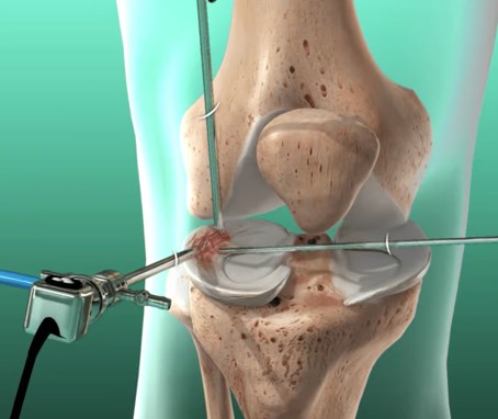 Arthroscopy Procedure - Joint Examination