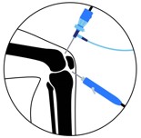 Arthroscopy Surgery