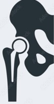 Joint Replacement