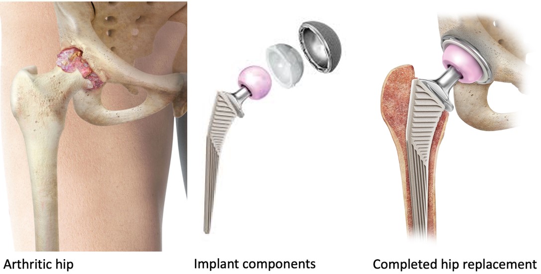 Hip Replacement Surgery