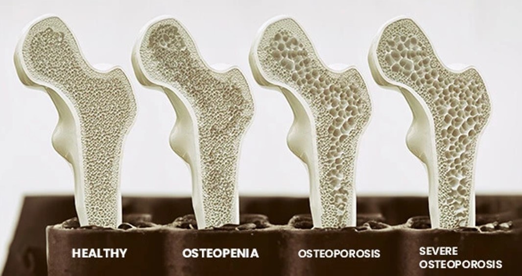 Pathological Fracture
