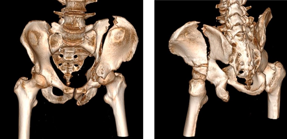 Pelvis & Acetabular Fracture