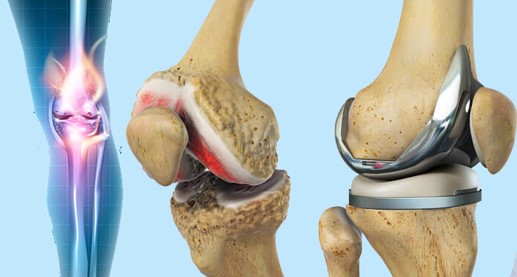 Knee Replacement Surgery